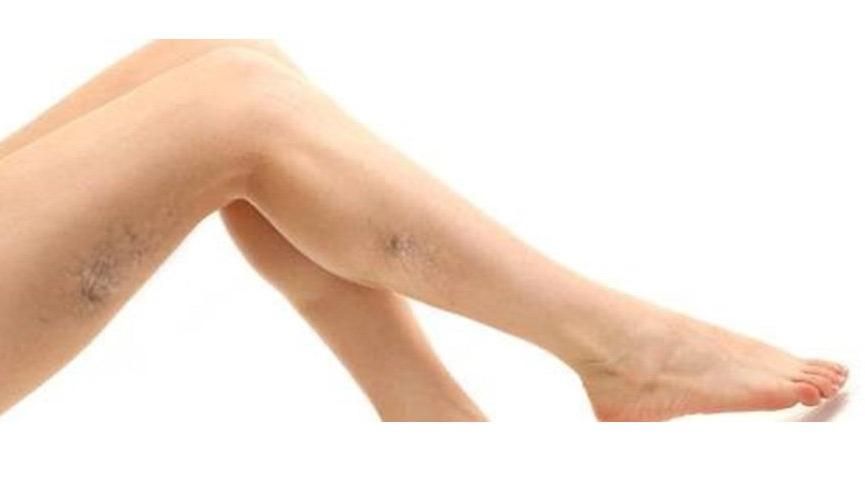 Lazerle Kılcal Damar Varis Tedavisi