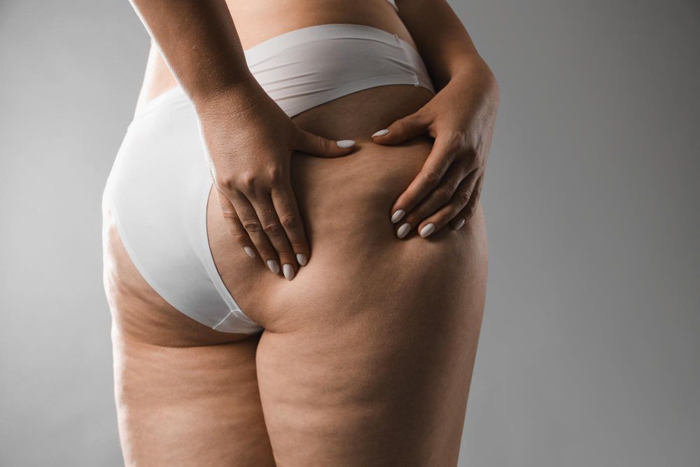 Lipedema: Sintomas, Graus e Tratamentos da Doença
