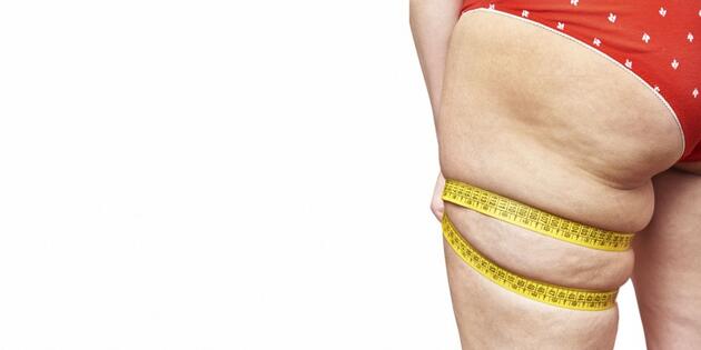 Lipödem Nedir? 3