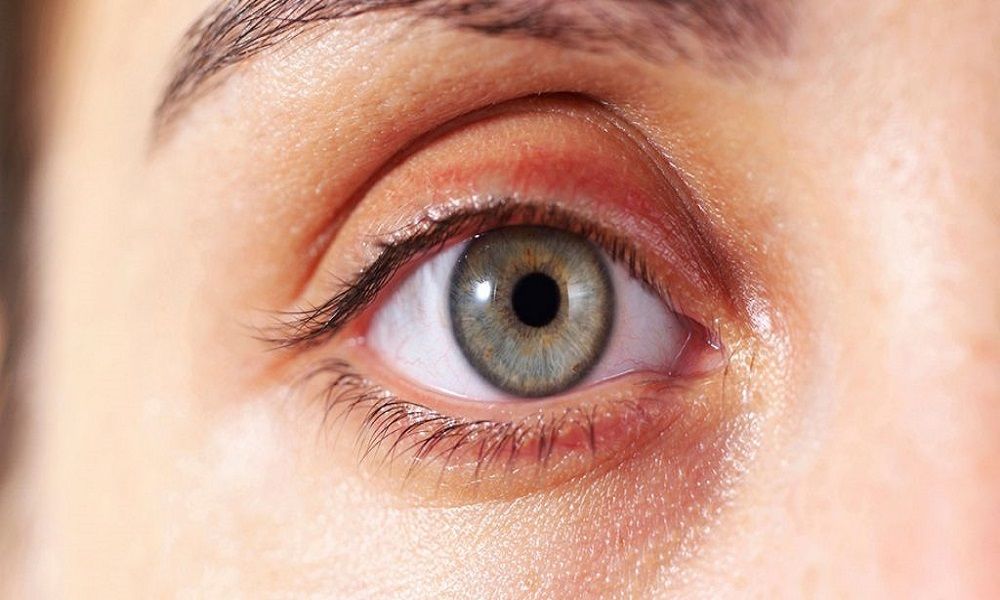 Makula Dejenerasyonu (Sarı nokta hastalığı)