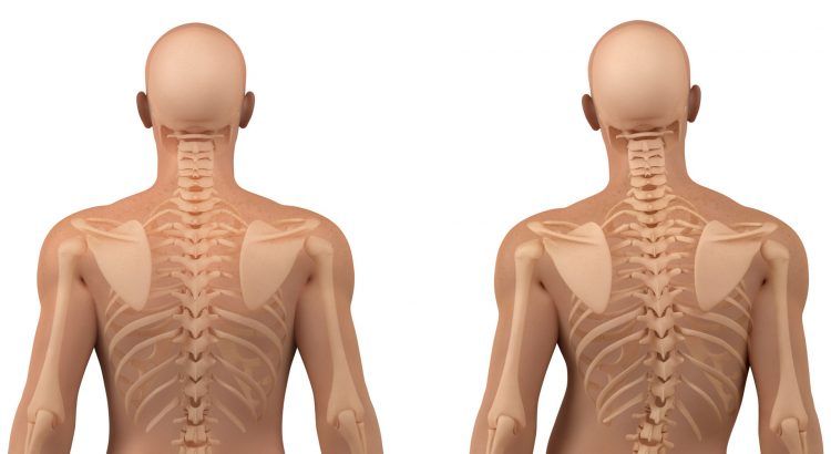 Omurga Sağlığı (Skolyoz – Kifoz – Lordoz) Rehabilitasyonu