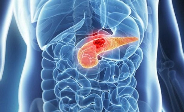 Pankreas Kanseri 7