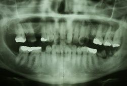 hypnose-gegen-zahnarztangst