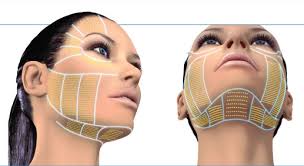 PDO İplerle Lifting (Yüz germe)