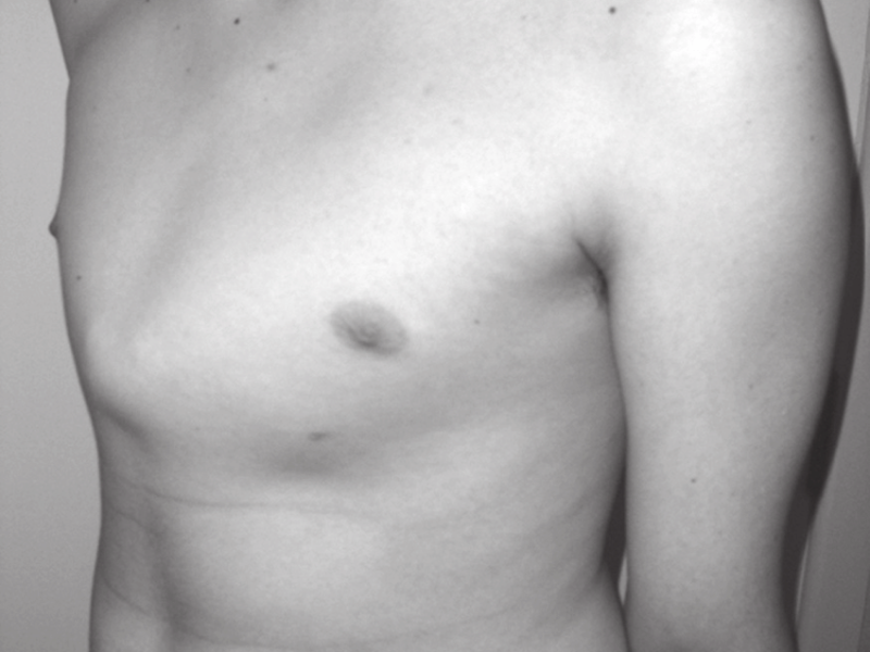 Pektus Karinatum (Güvercin Göğsü)