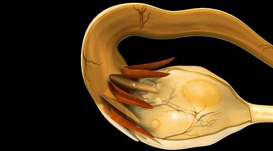 Polikistik Over Sendromunda Erken Tanı Önemlidir
