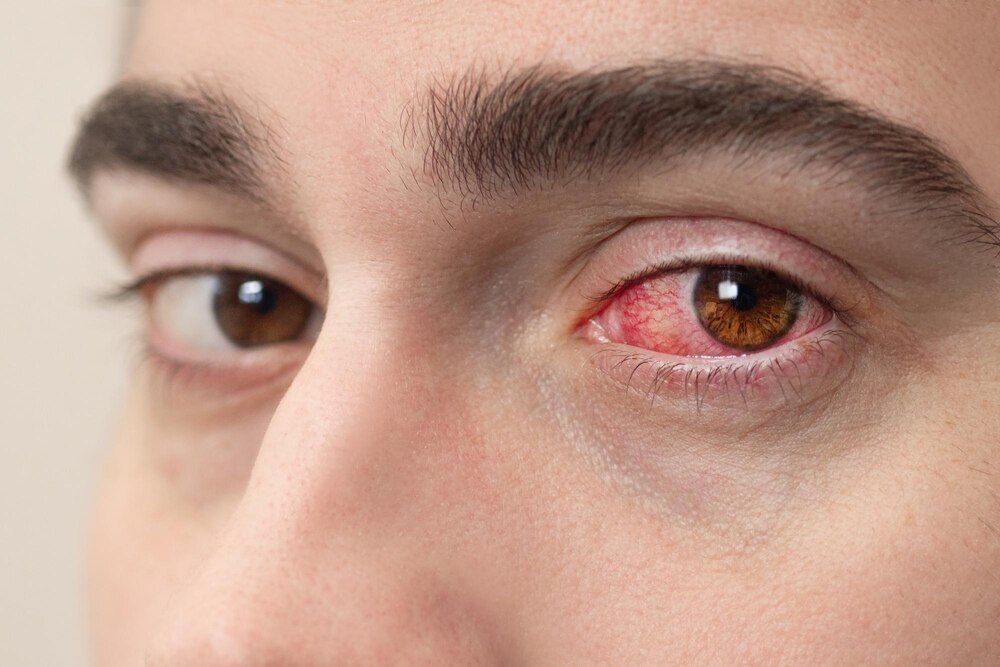 olho vermelho injetado de sangue de homem afetado por conjuntivite ou após alergia