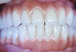 weltnichtrauchertag-die-auswirkungen-des-rauchen-auf-die-zaehne