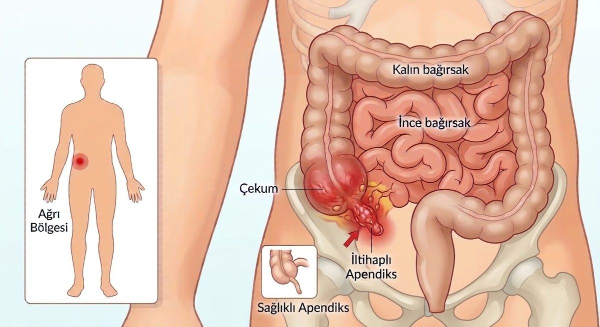 cocuklarda-apandisit-belirtileri-nelerdir-ne-zaman-acile-basvurulmali-op-dr-selim-ozkaya