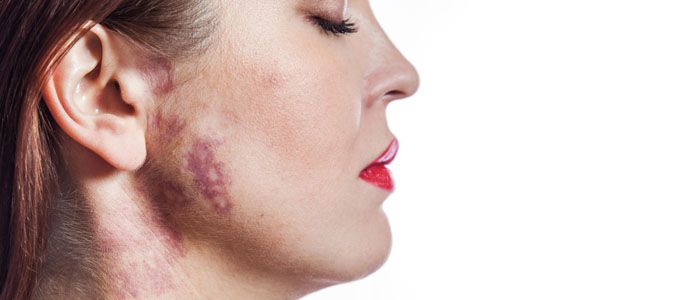 Şarap Lekesi Tedavisi