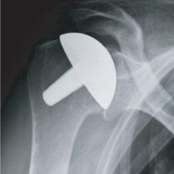 schulterarthrose-schulterschmerzen