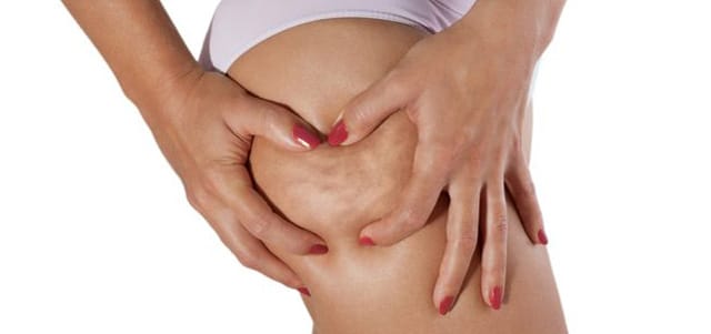 Selülit Nedir? Nasıl Tedavi Edilir?