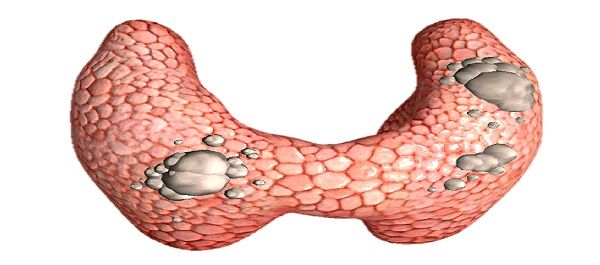 Tiroid Nodülleri İçin Düzenli Kontrol Şart
