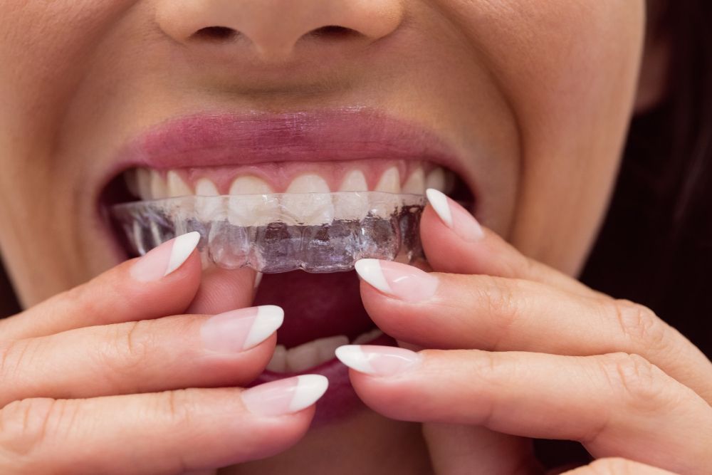 invisalign sendo colocado no dente
