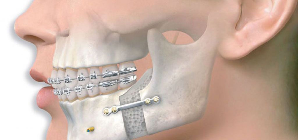 Travmatik Çene Kırıklarının Tedavisi