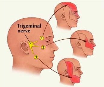 TRİGEMİNAL NEVRALJİ 3