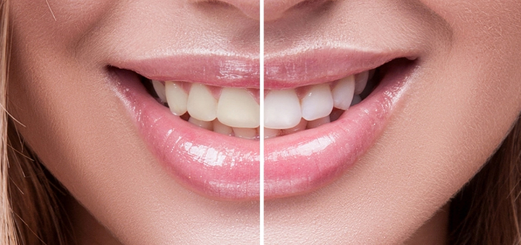 Vizajizm Uygulamaları İle Estetik Diş Hekimliği Tedavi Konsepti