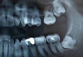 weisheitszaehne-als-unruhestifter