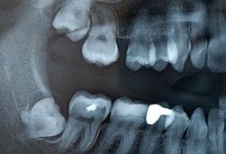 weisheitszaehne-entfernen