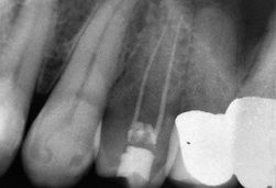 wurzelbehandlung-wurzelspitzenresektion