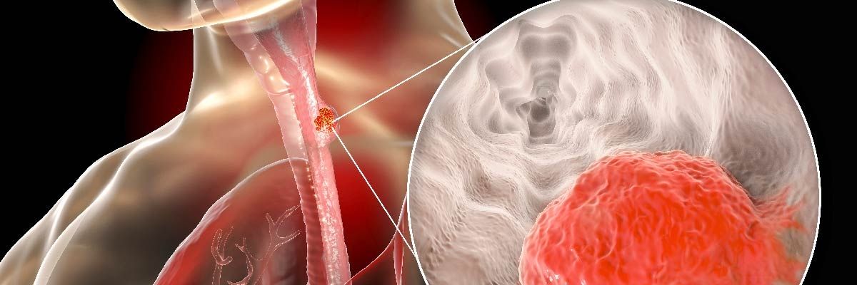 Yemek Borusu Ülseri