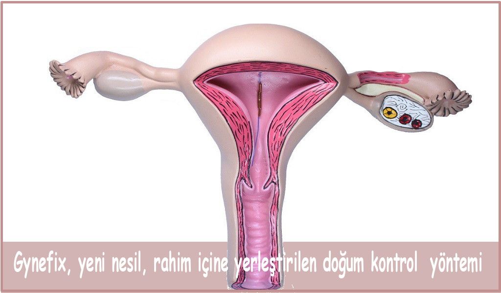 YENİ NESİL SPİRAL İLE KORUNMA YÖNTEMİ: GYNEFİX