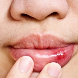 Afte Cosa Sono Sintomi Cause Cure Rimedi Naturali Pazienti It