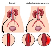 Aneurisma