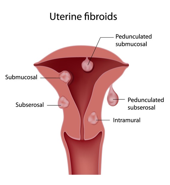 Crescite uterine