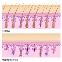 Alopecia