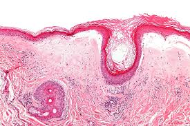Lichen sclerosus
