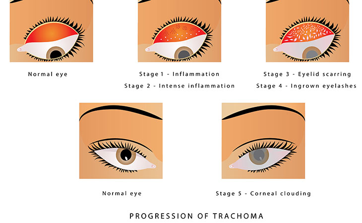 Tracoma