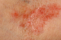 Eczema