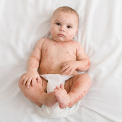 Sesta Malattia Cos E Sintomi Cause Trattamenti Contagio Pazienti It