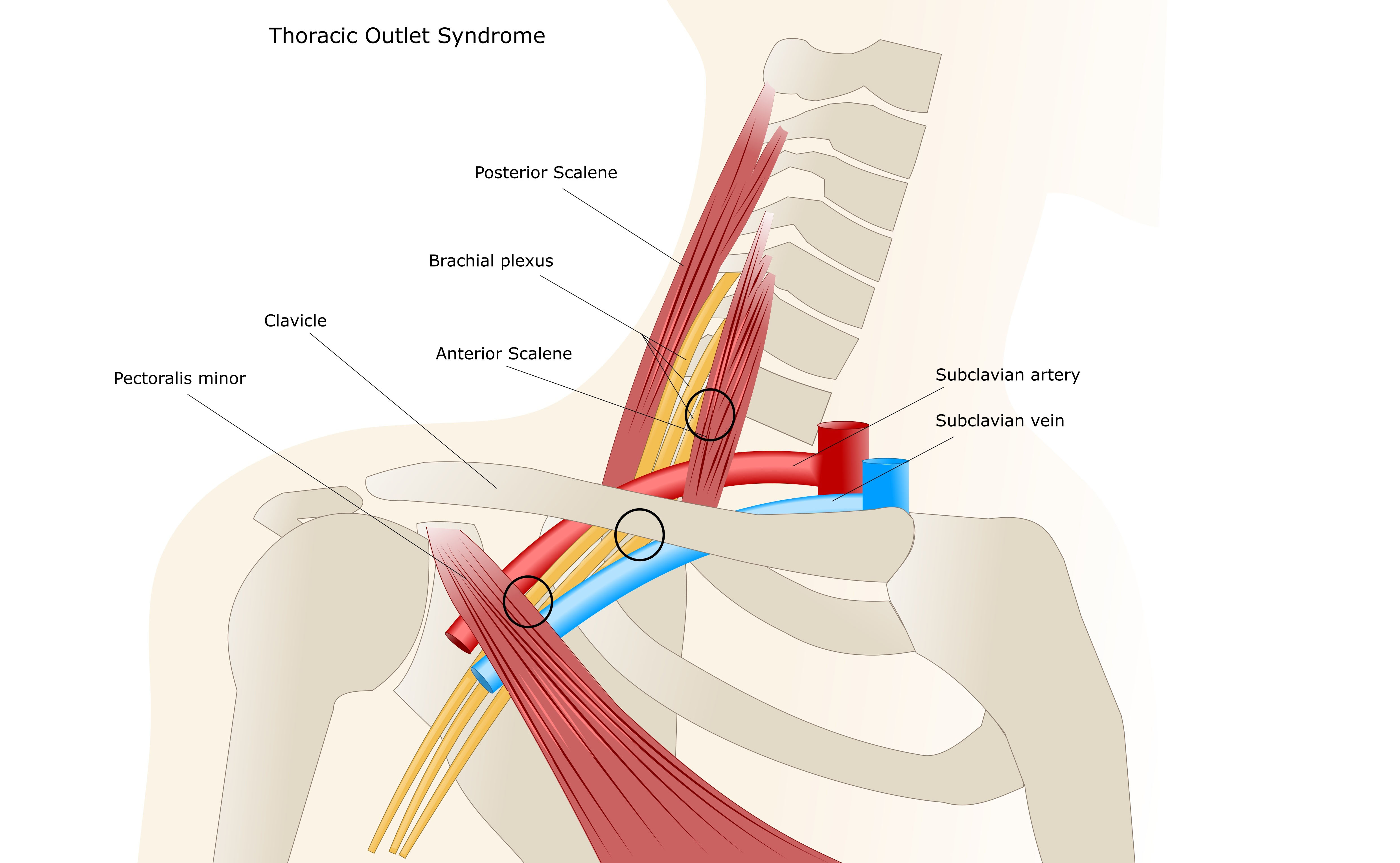 Sindrome dello stretto toracico superiore