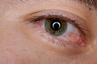 Congiuntivite allergica
