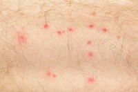 Allergies to insect bites