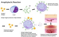 Anaphylactic shock