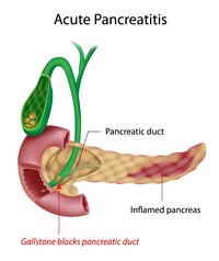 Pancreatitis
