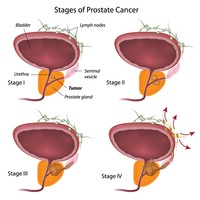Tumore alla prostata