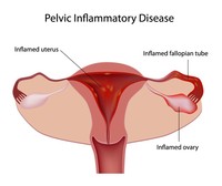 Sindrome_dolorosa_pelvica | Pazienti.it