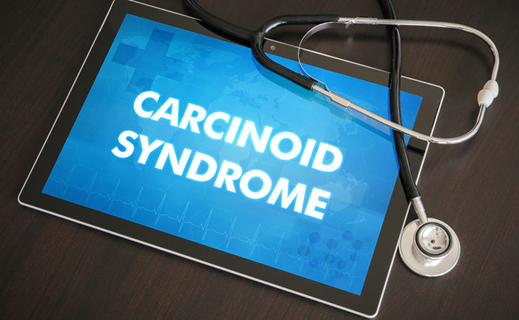 Sindrome da carcinoide