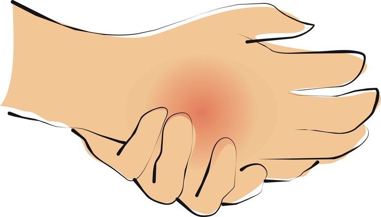 Causalgia