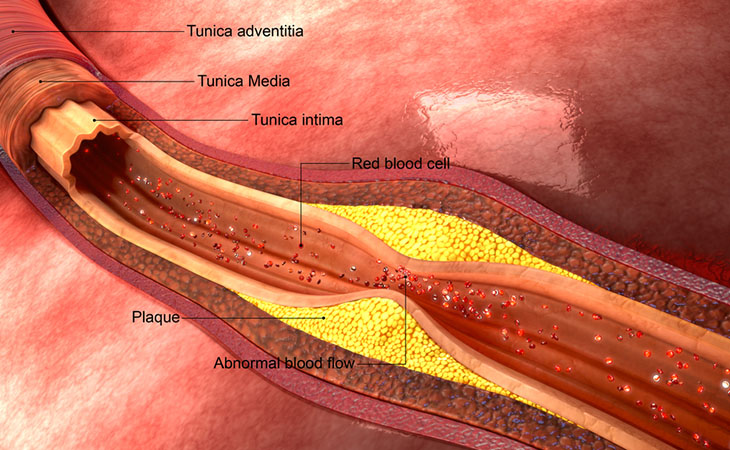 Malattia di Kussmaul