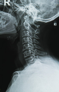 Artrosi cervicale