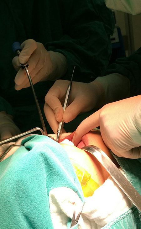 Chirurgia piezoelettrica