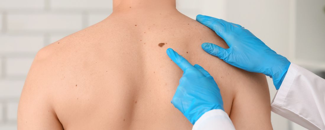Tumore della pelle