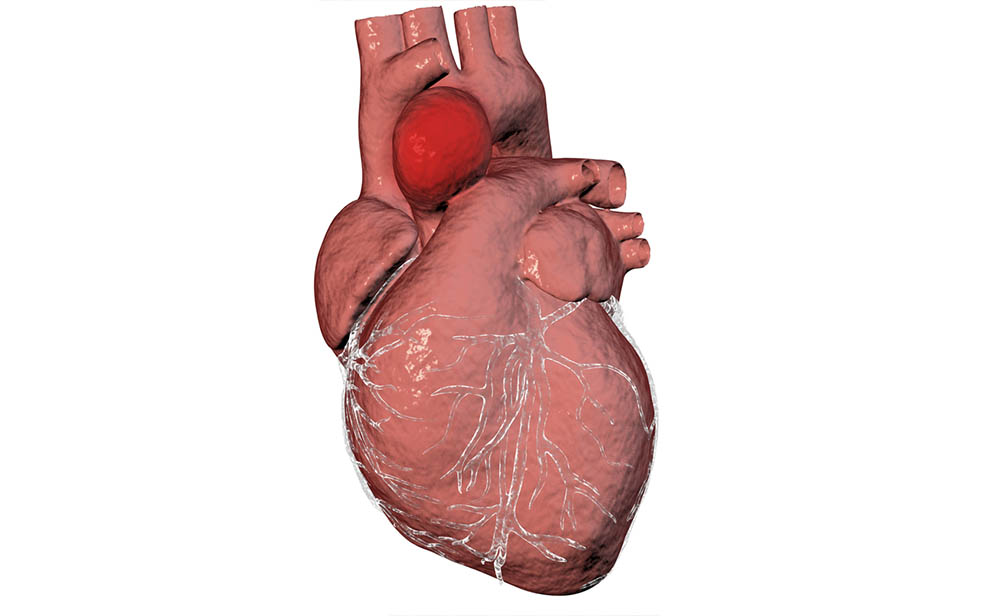 Aneurisma ventricolare