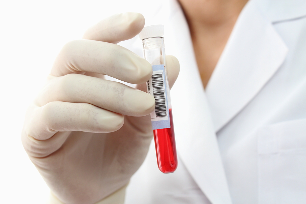 Alpha-2-macroglubulina