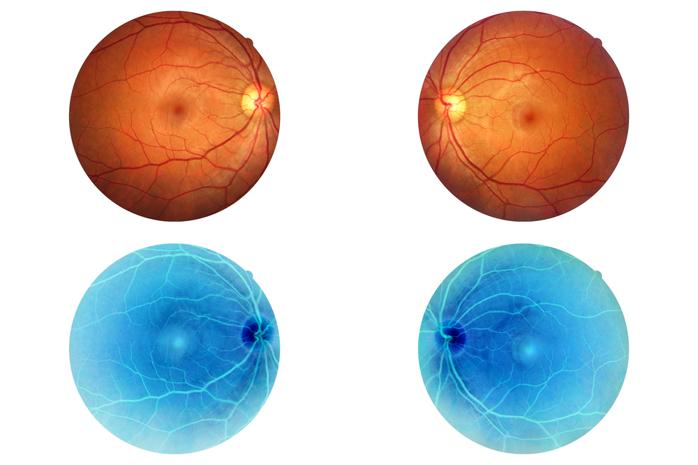 Bastoncello retinico